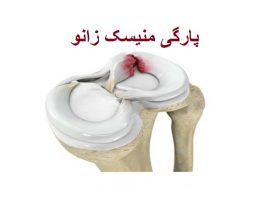 پارگی منیسک