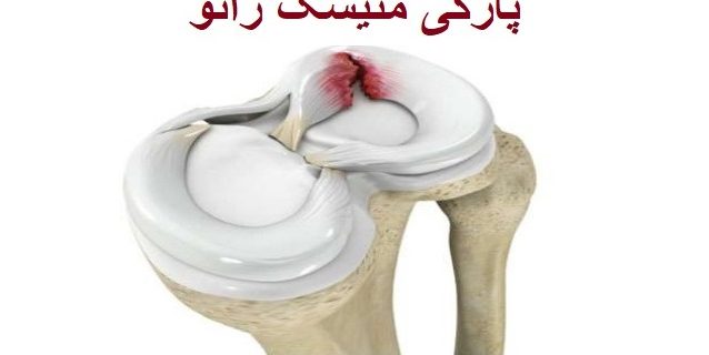پارگی منیسک