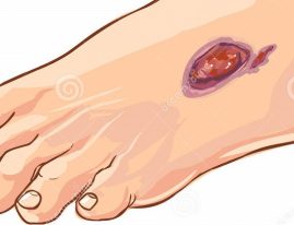 عوارض دیابت در پا