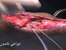 جراحى تاندون آشيل