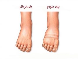 علت ورم پا
