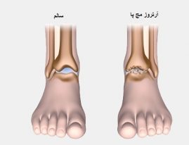 آرتروز مچ پا
