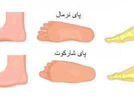 پای شارکو