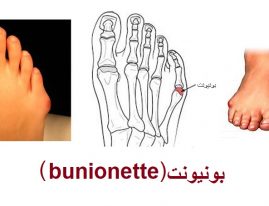 بونیونت