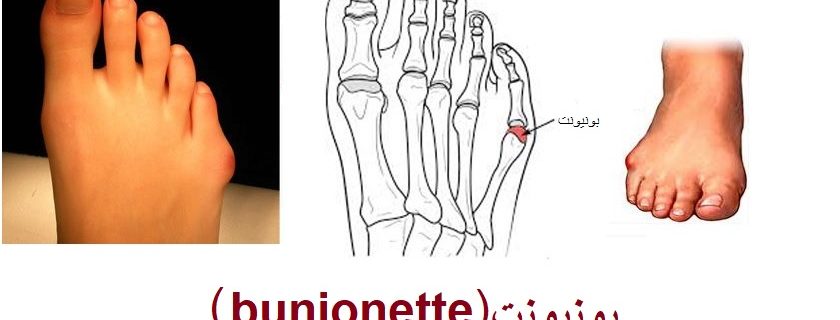 بونیونت
