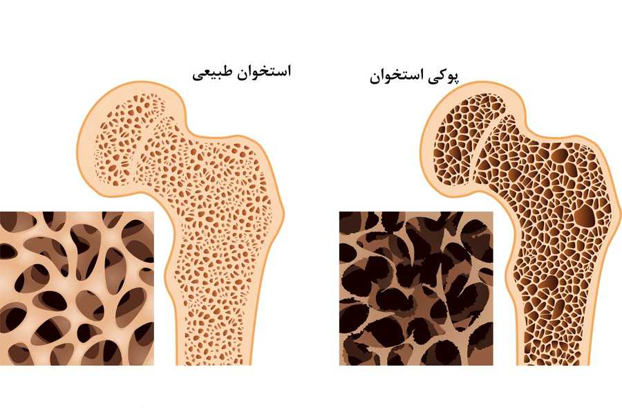 تشخیص پوکی استخوان