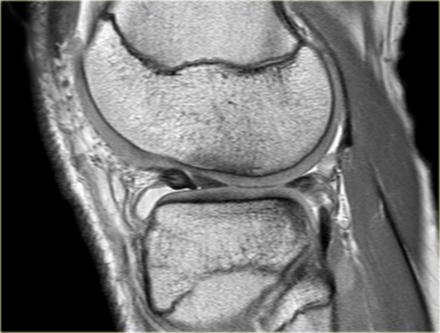 عکس mri پارگی مینیسک زانو
