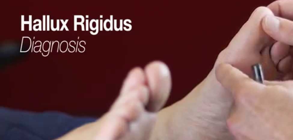 خشکی شست پا یا هالوکس ریجیدوس