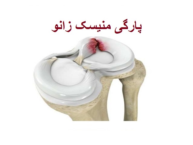 پارگی مینیسک
