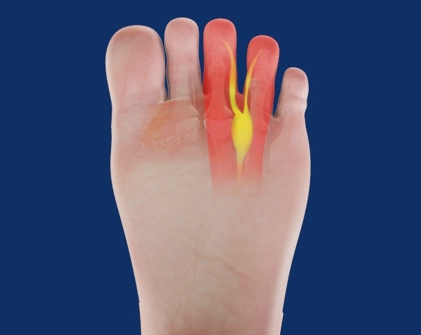 تزریق کورتن به انگشتان پا