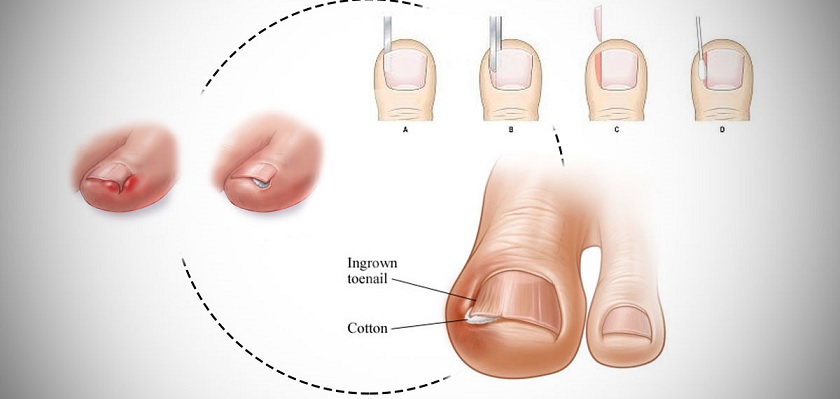 جراحی فرو رفتن ناخن در گوشت پا
