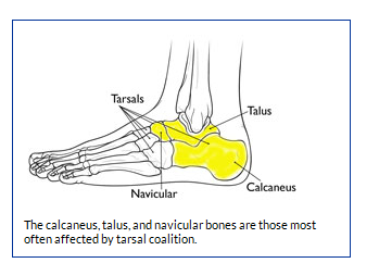 اتصال غیر طبیعی استخوان های پا