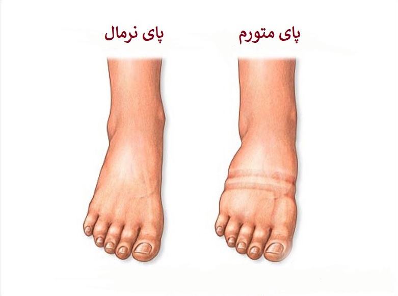 علت ورم قوزک پای چپ