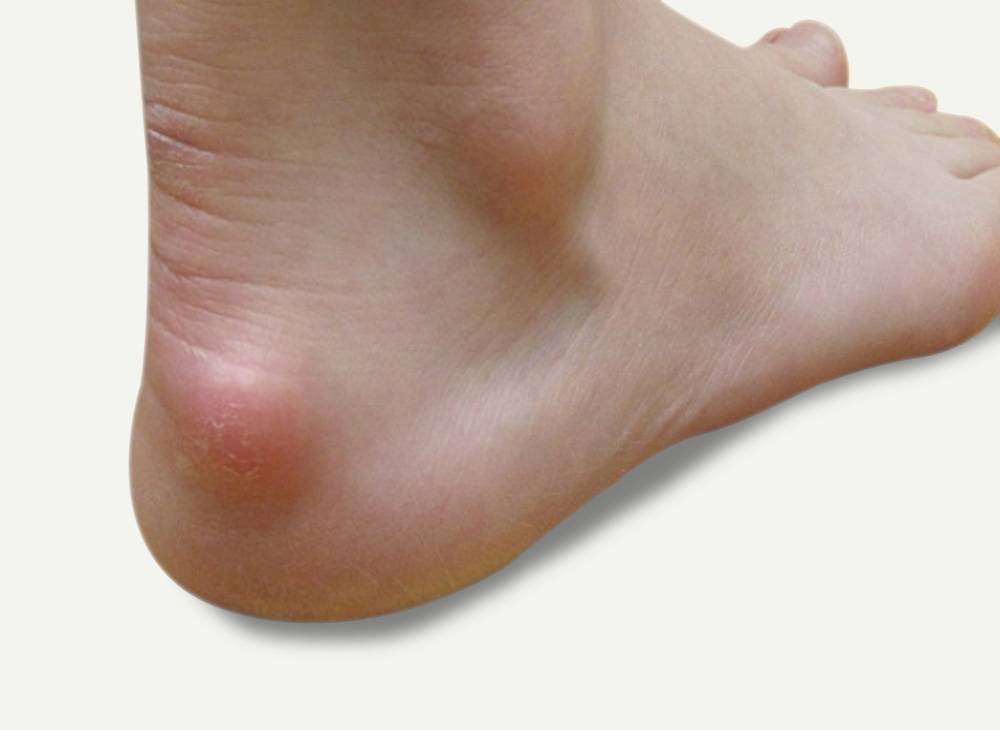 کیست پشت پاشنه پا