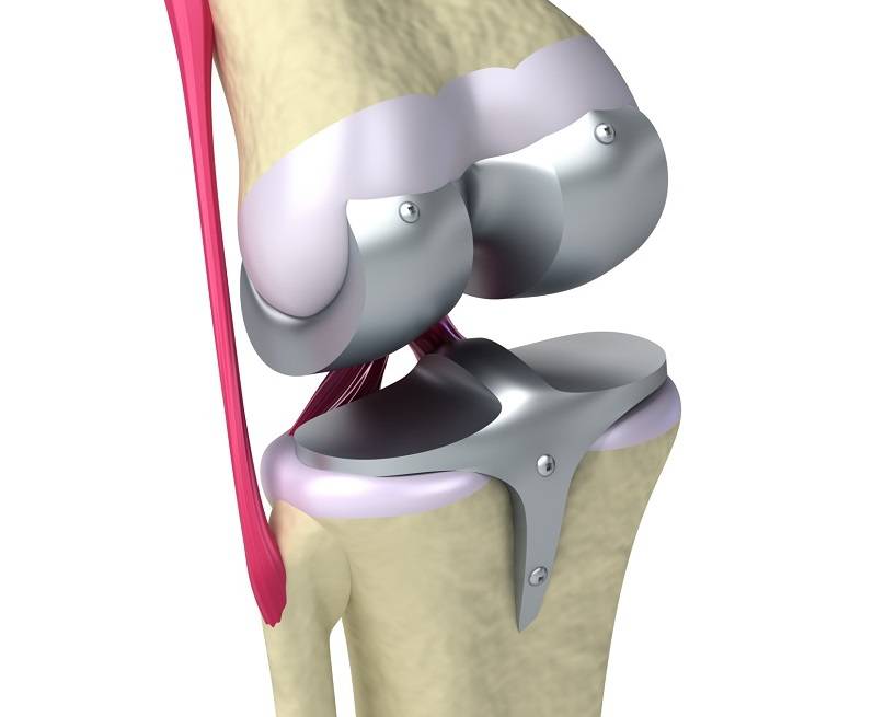 عمل تعویض مفصل زانو