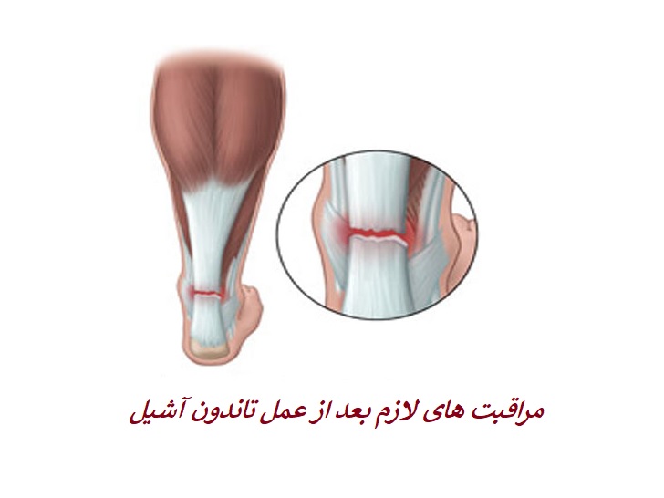 بعد از عمل تاندون آشیل