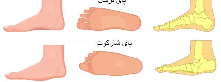 پای شارکو