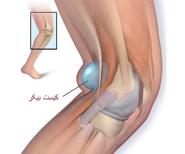 ایا کیست زانو خطرناک است