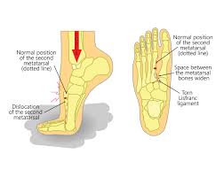 آسیب دیدگی لیسفرانک