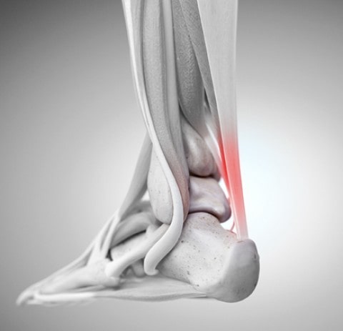 شکستگی استخوان تالوس