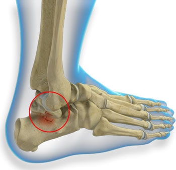 علل شکستگی تالوس در مچ پا