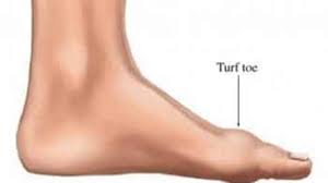 انگشت چمنی (turf toe) چیست