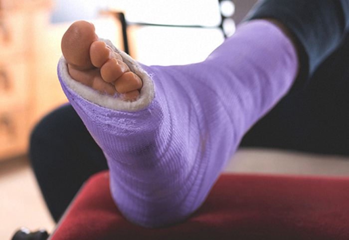 مراقبت های بعد از باز کردن گچ پا