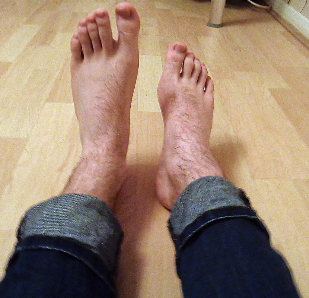 سندرم پای کوتاه
