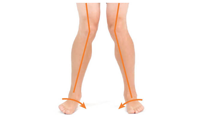 مشکل زانوی ضربدری