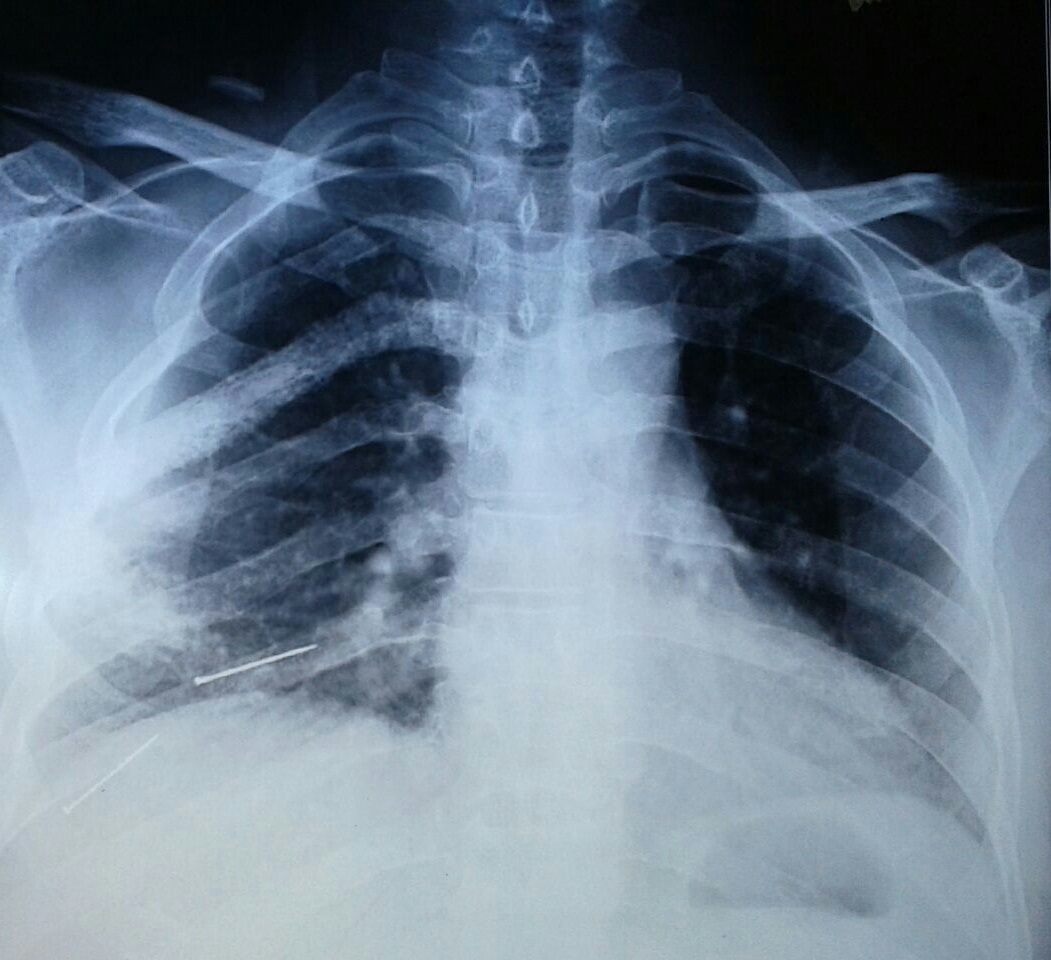 اسکن هسته ای استخوان