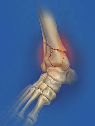 شکستگی پایلون