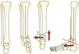 آناتومی استخوان ساق پا