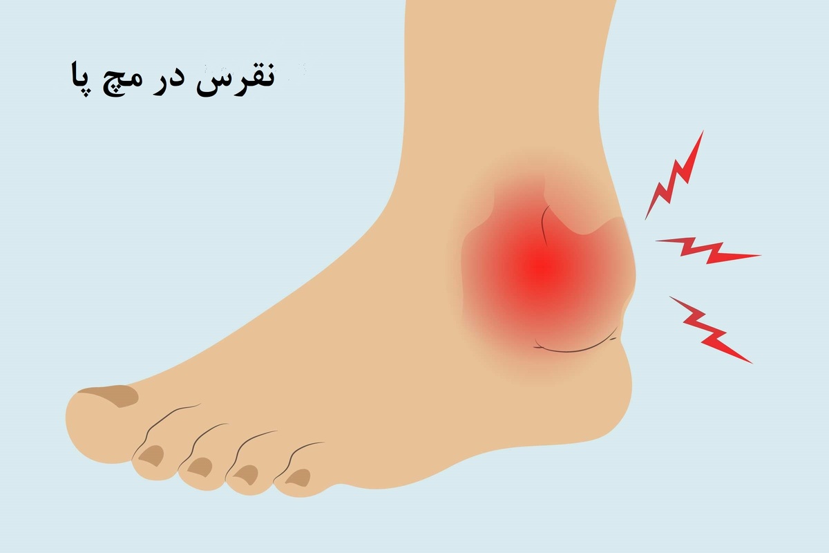 نقرس مچ پا