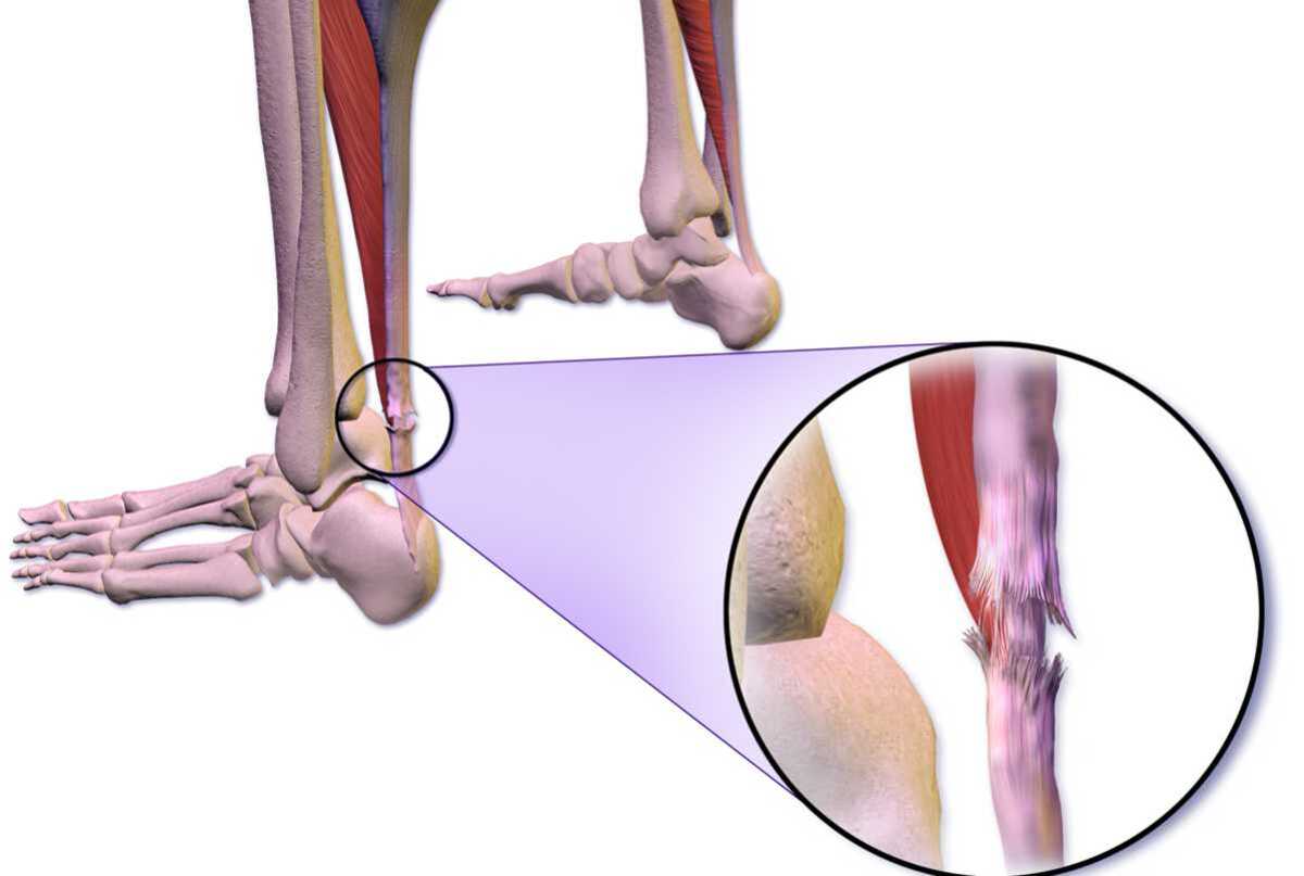 کوتاهی اشیل پا