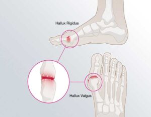 هالوکس ریجیدوس.