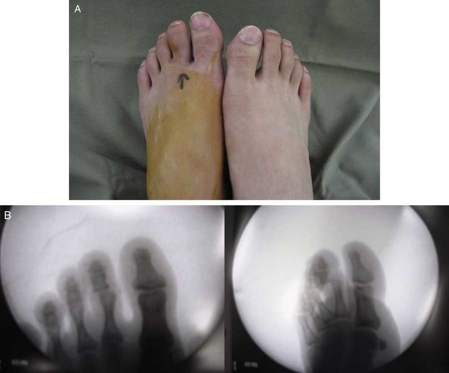 در رفتگی انگشت پا