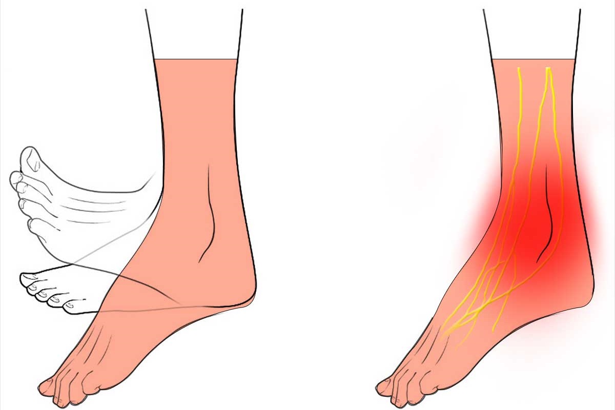 افتادگی مچ پا