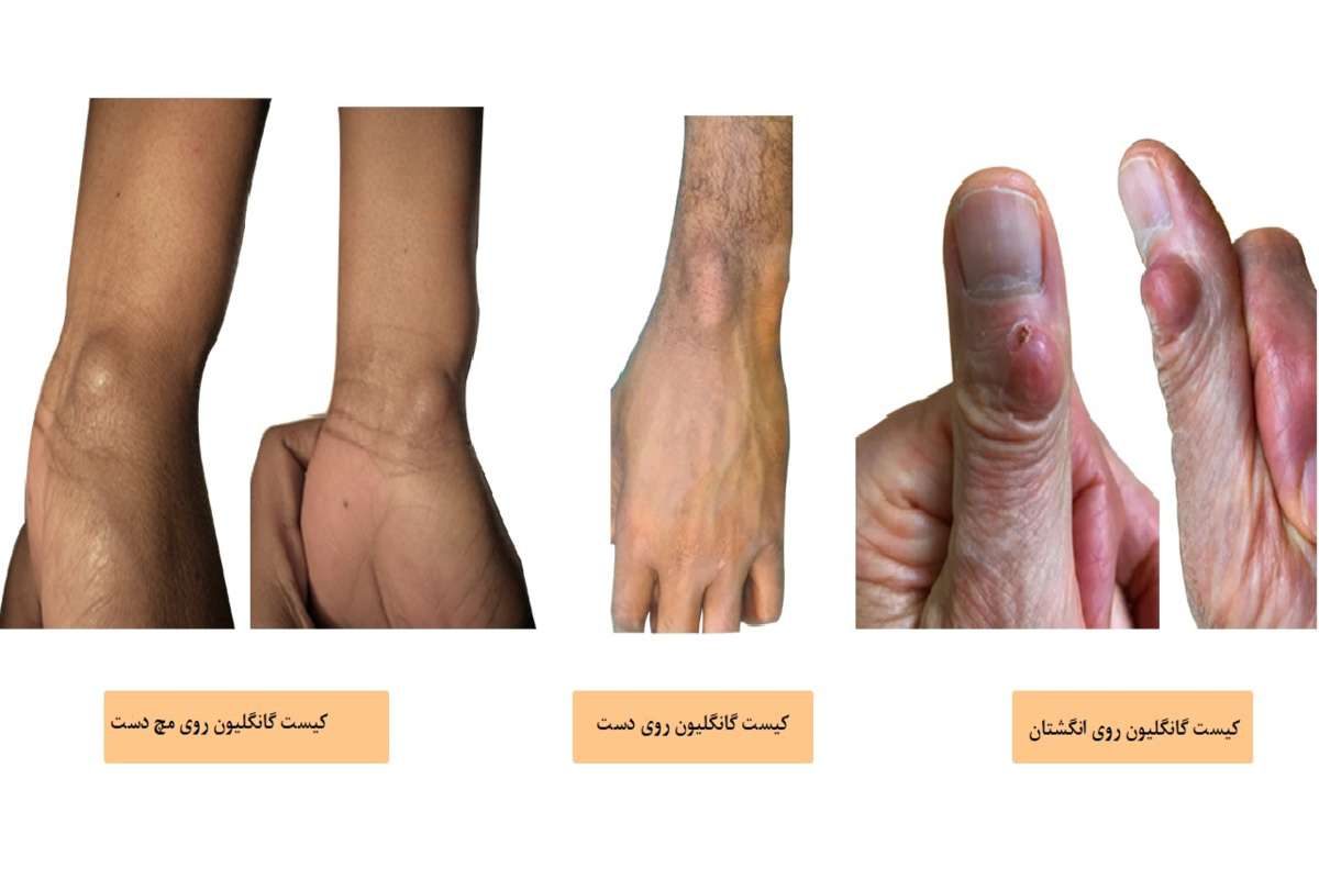 کیست گانگلیون