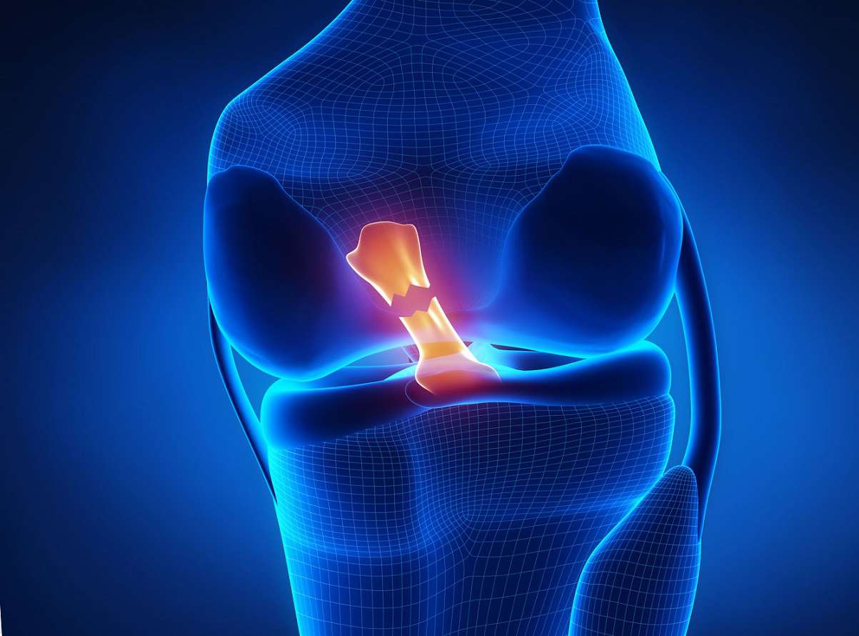 علائم پارگی رباط صلیبی زانو