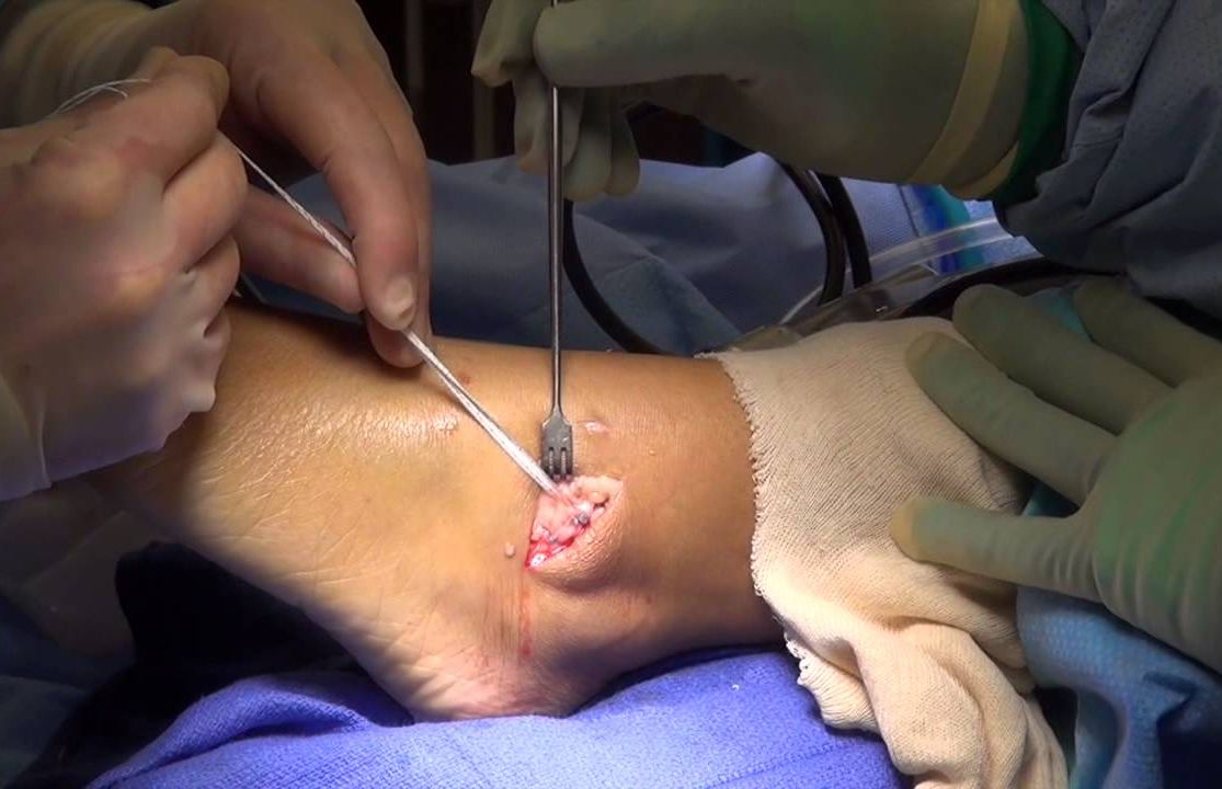 درمان پارگی رباط مچ پا