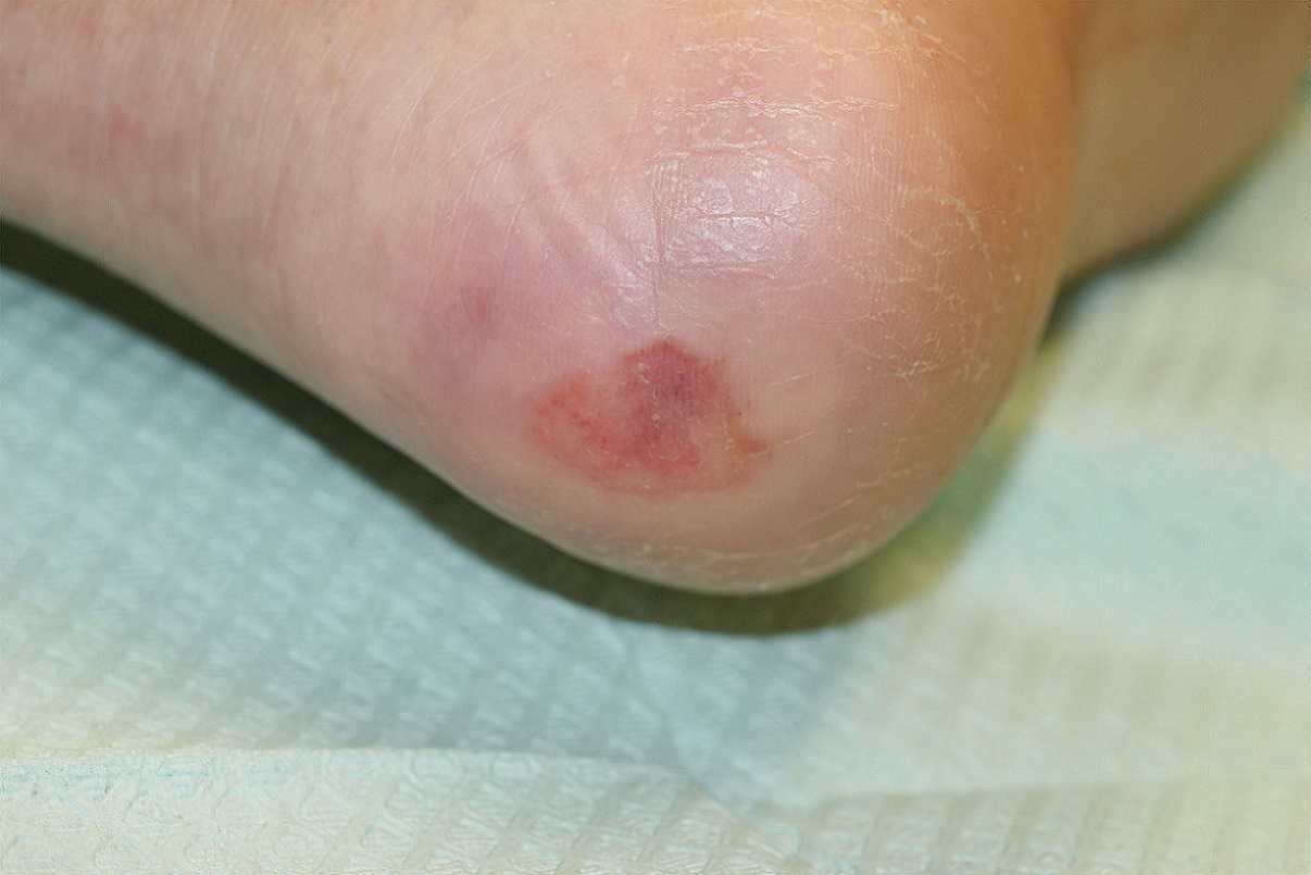 Diabetic Sores On Feet Pictures