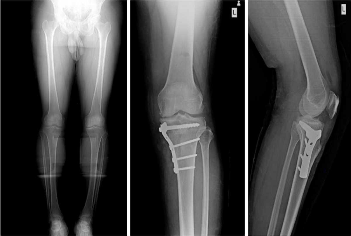 جراحی پای پرانتزی