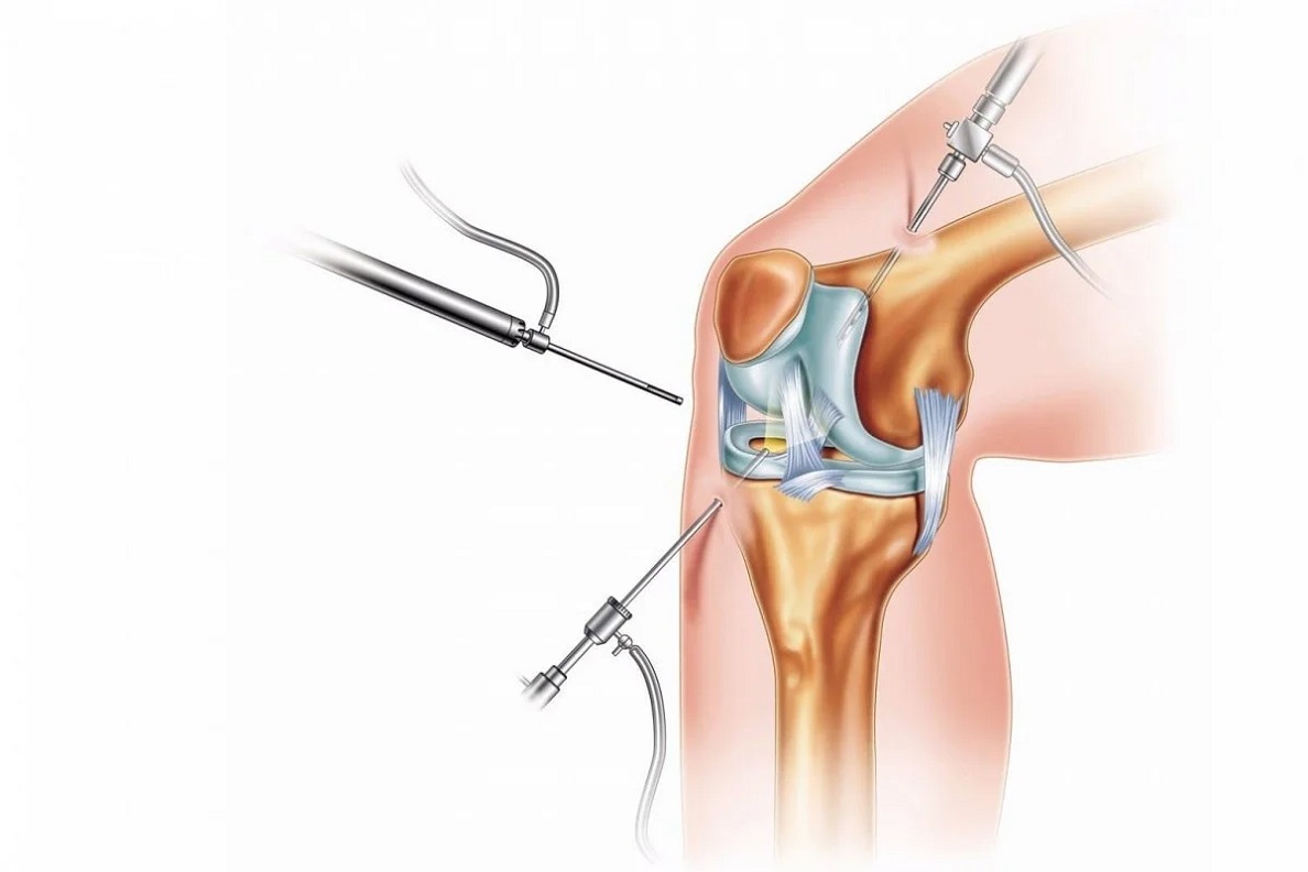 عمل آرتروسکوپی زانو