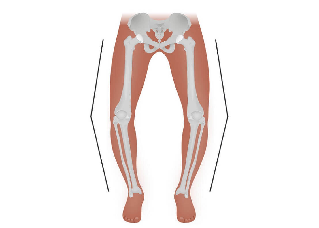 بهترین سن برای درمان پای پرانتزی