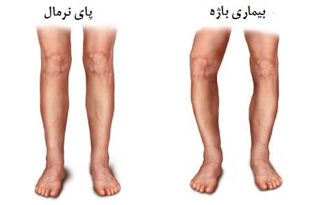 بیماری پاژه