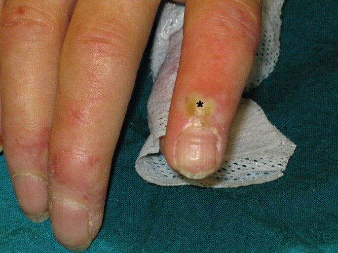 استئومیلیت یا عفونت استخوان