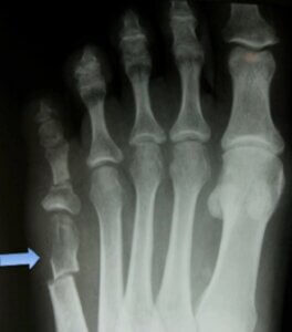 مدت زمان جوش خوردن استخوان متاتارس پنجم