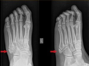 شکستگی متاتارس پنجم