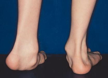 دفورمیتی مچ پا