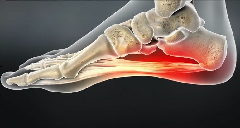 درد کف پای چپ در زنان
